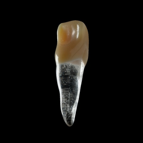 BIOMED 3D Tooth - Ząb treningowy - 9 skalcyfikowany