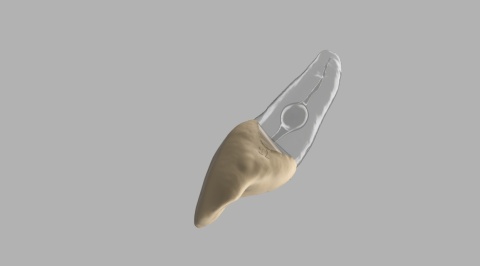 BIOMED 3D Tooth - Ząb treningowy - 9 z resorpcją