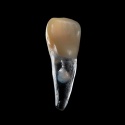 BIOMED 3D Tooth - Ząb treningowy - 9 z resorpcją